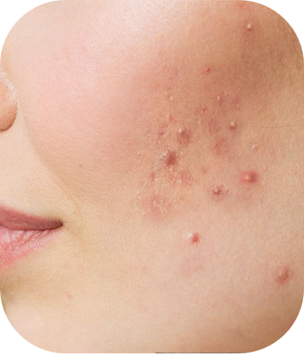 Acne & Blackheads