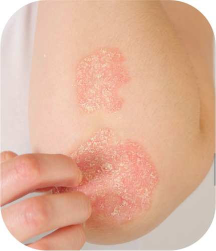 Eczema