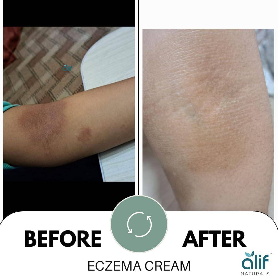 Eczema Cream | 200 ML - Alif Naturals